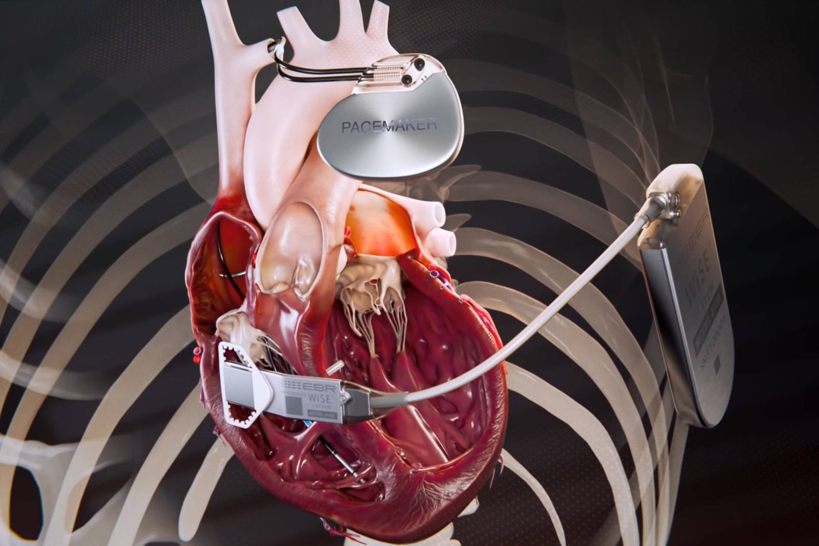 EBR Systems render of the WiSE CRT System in the chest: the receiver-electrode inside the heart, the transmitter and battery beside the ribs, and a co-implanted pacemaker