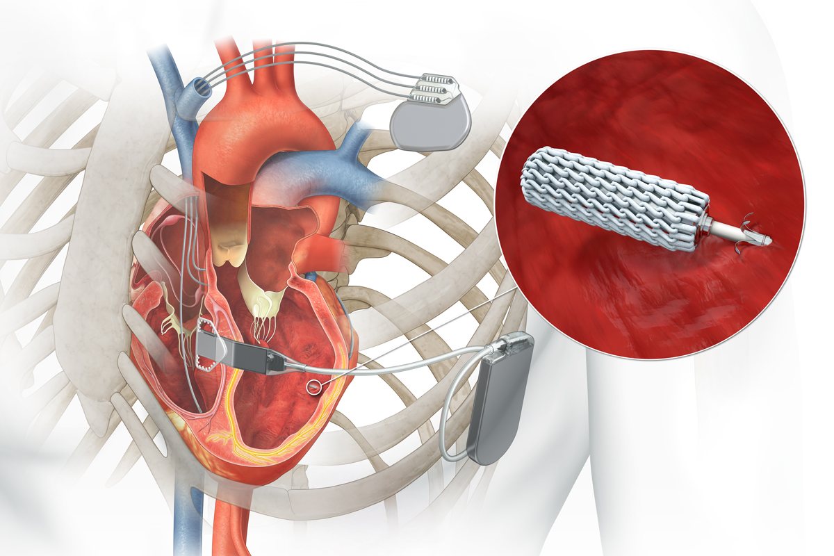 Medical illustration of the WiSE CRT System implanted with a pacemaker, with an inset showing the wireless receiver-electrode anchored in the left-ventricle wall
