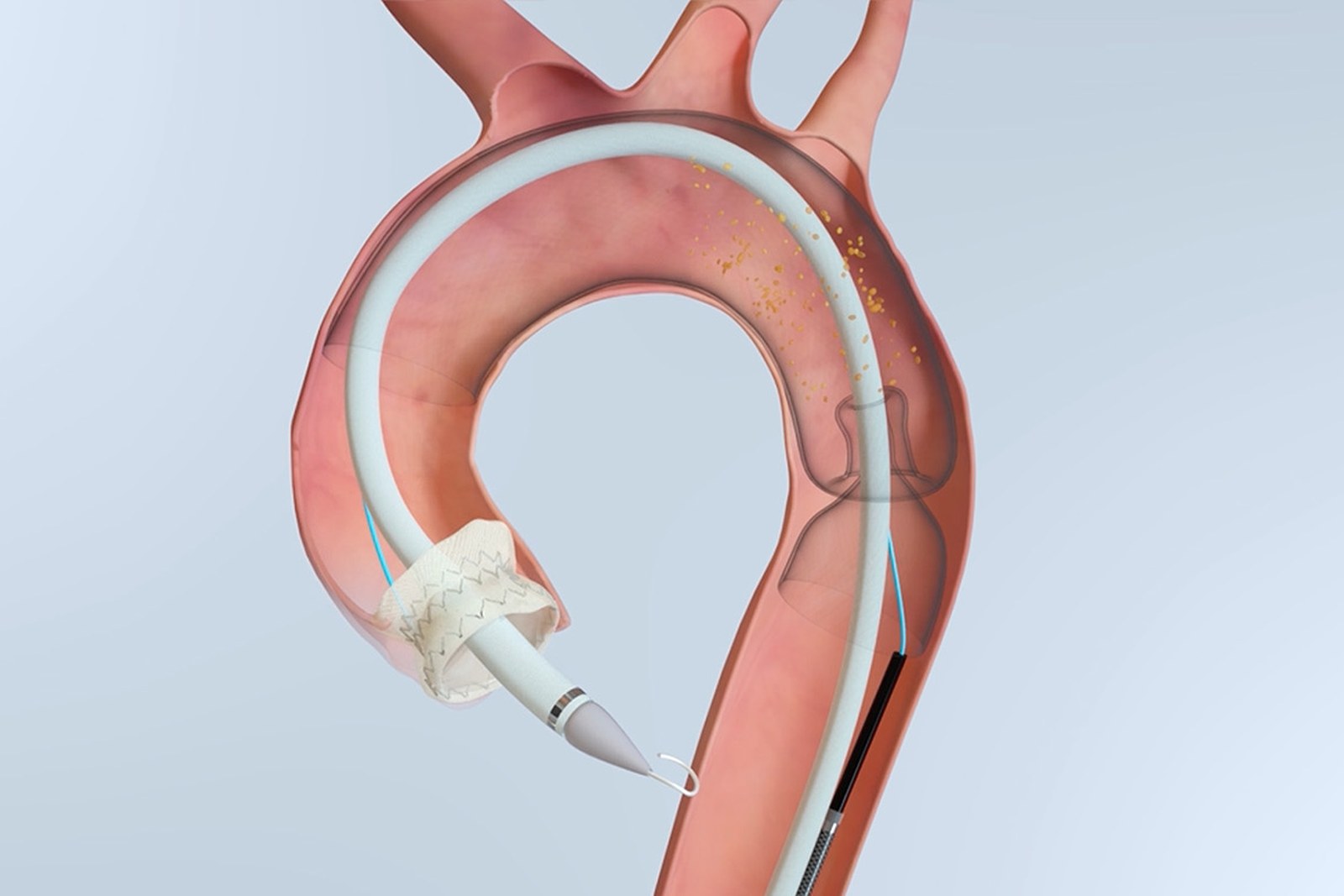 Illustration of the Emboliner embolic protection filter deployed across the aortic arch during TAVR, with the transcatheter valve delivery system passing through its central lumen and captured debris shown as gold particles