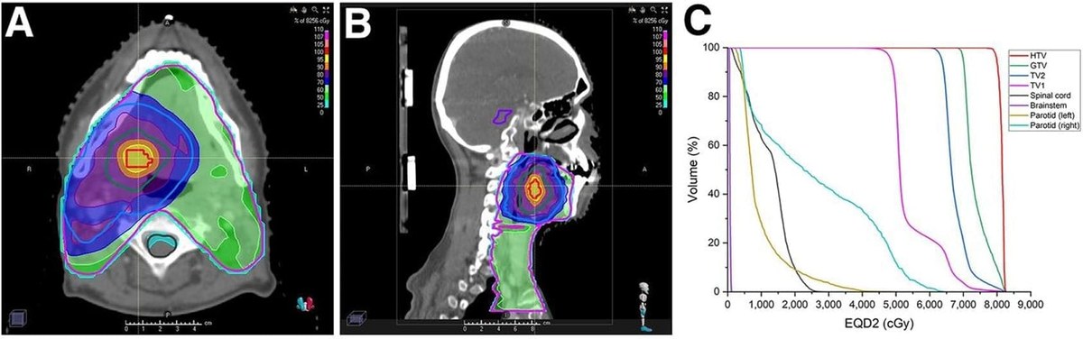 F-MISO-guided radiation dose distributions shown on axial and sagittal CT slices alongside a dose-volume histogram