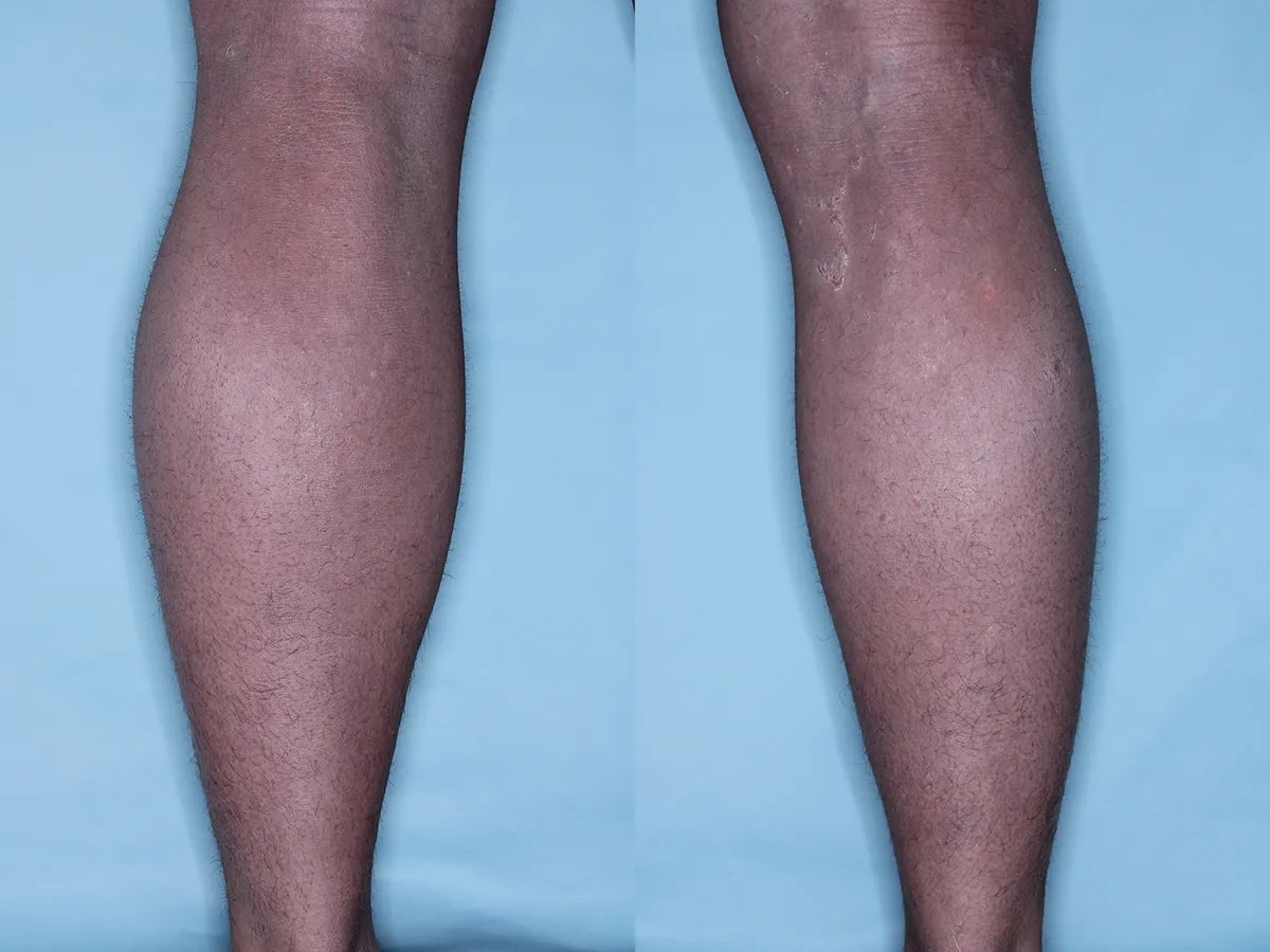 Clinical photograph of a study subject's lower legs after 12 weeks of twice-daily QRX003, the skin clear of scaling and redness