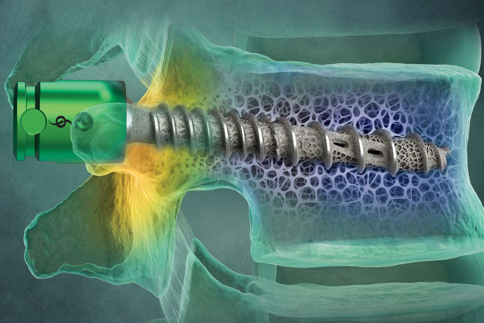 Cutaway illustration of SI-BONE&rsquo;s iFuse Granite Onyx implant threaded through a vertebral body, its porous 3D-printed surface shown against the surrounding trabecular bone