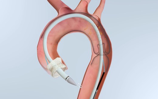 Illustration of the Emboliner embolic protection filter deployed across the aortic arch during TAVR